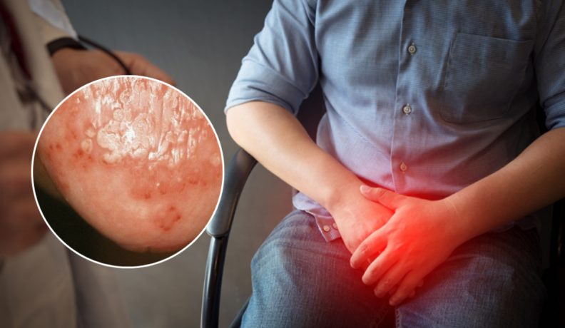 Triệu chứng nấm ngứa vùng kín nam giới