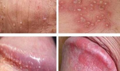 Trị vùng kín nam trị nấm ngứa bác sĩ khuyên dùng