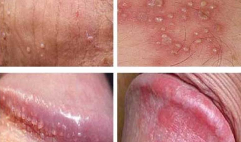 Trị vùng kín nam trị nấm ngứa bác sĩ khuyên dùng